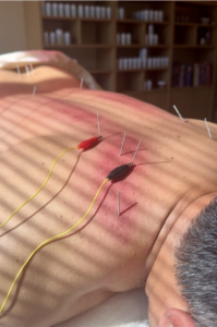 Acupuncture for neck pain in San Diego.