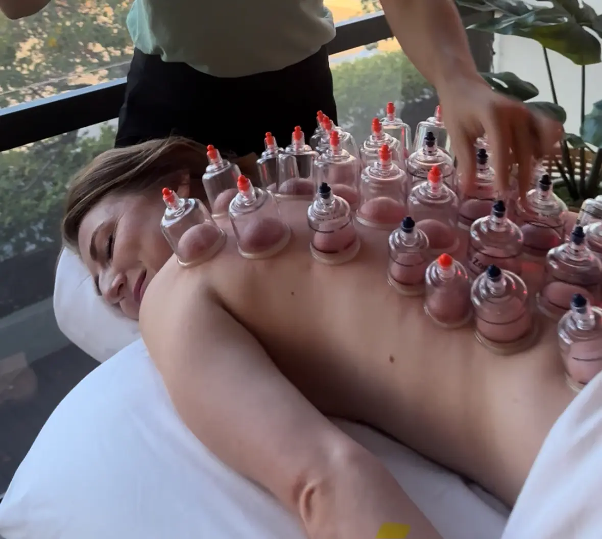 cupping in San Diego