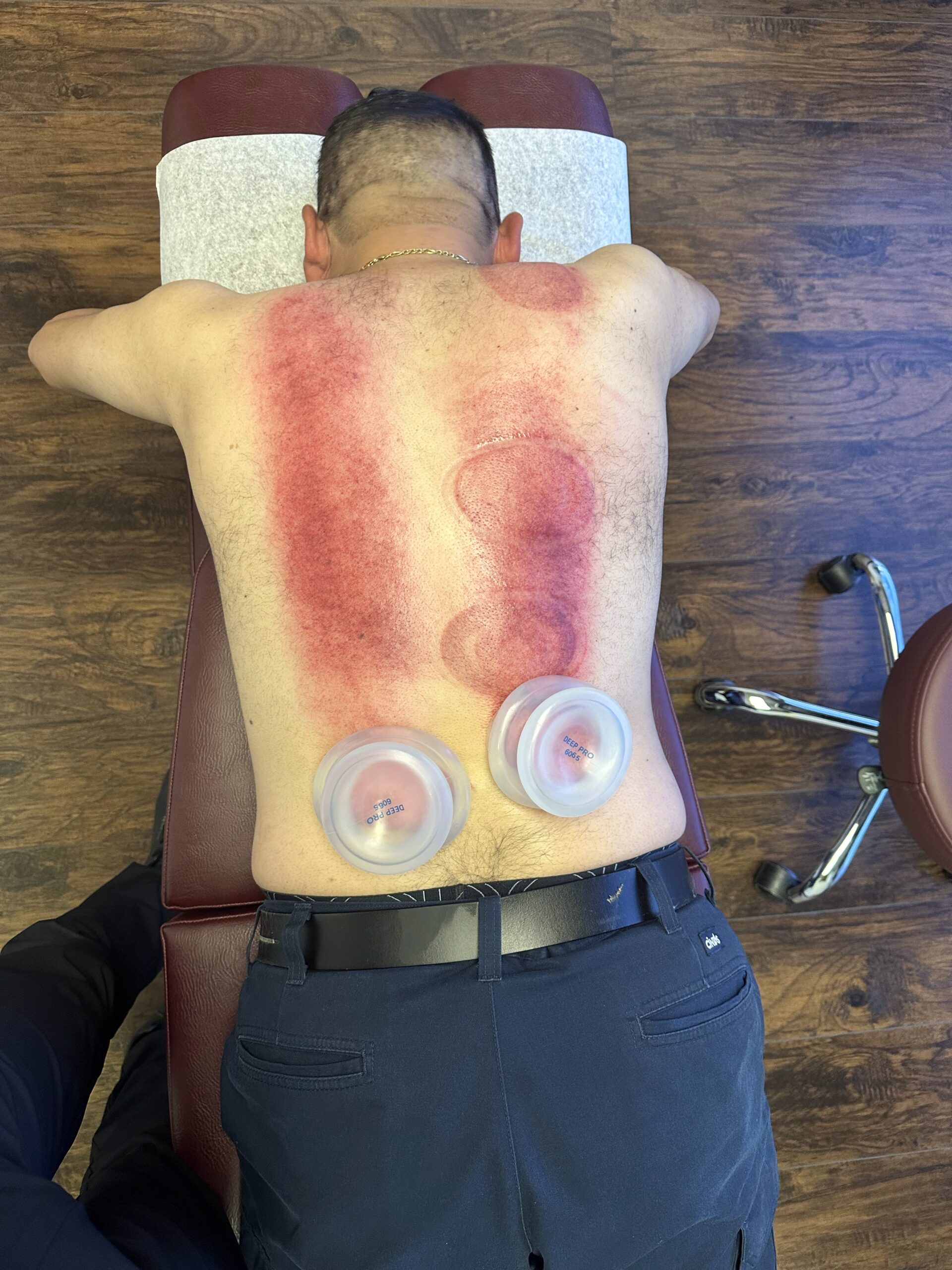 Gliding Cupping Holistic San Diego